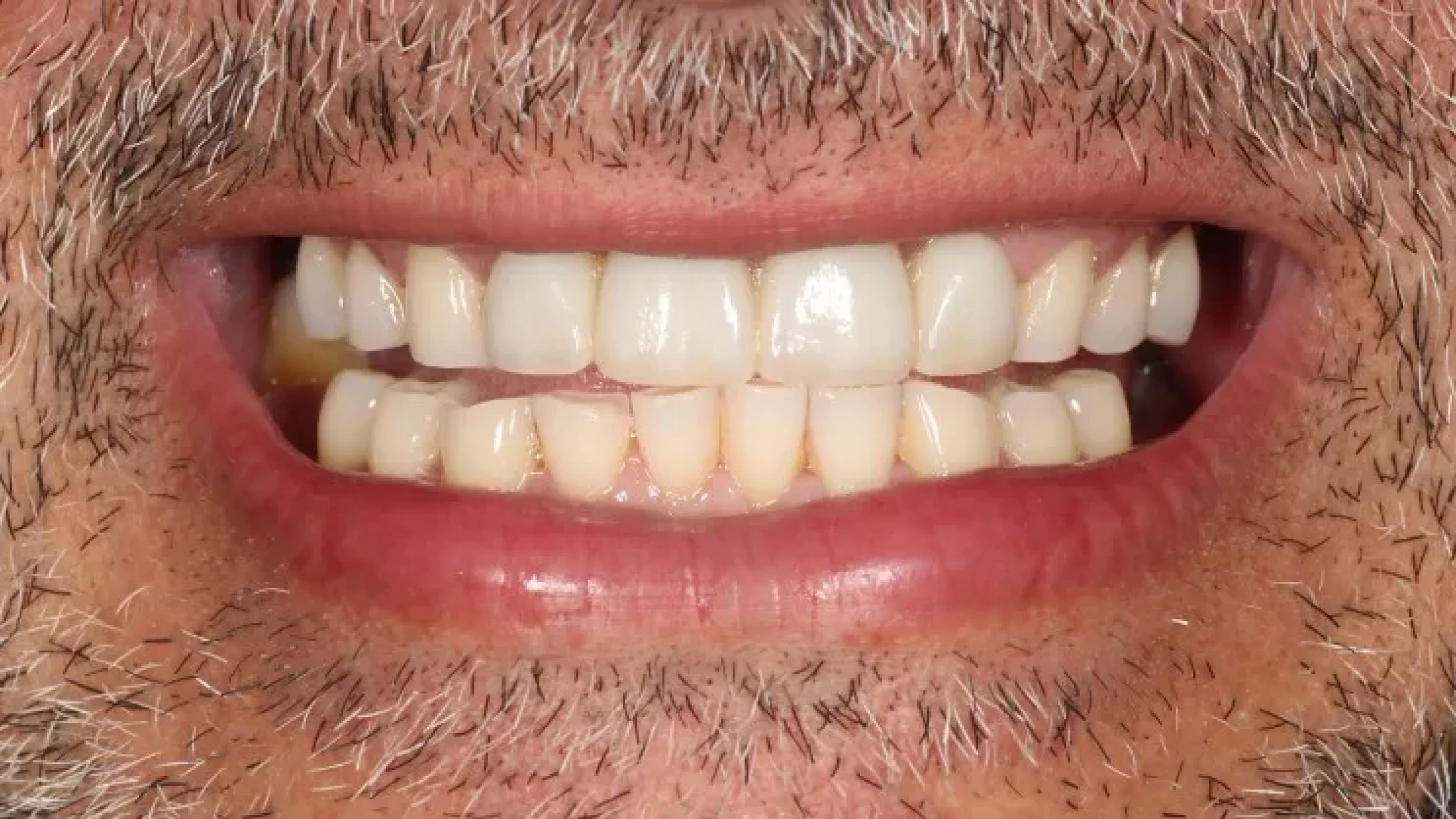 Gordon Dental Implants and Cosmetics Before After X