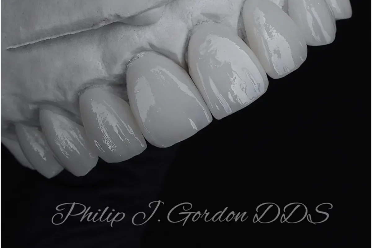 Gordon Dental-Living with a Damaged Tooth in Kansas City_ Discover How Cosmetic Crowns at Gordon Dental Can Restore Its Strength and Beauty