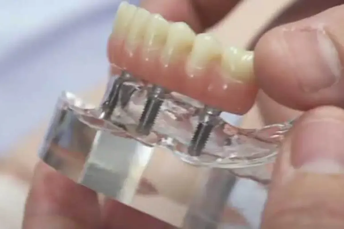 How Many Implants Do You Need to Replace Full Set of Teeth