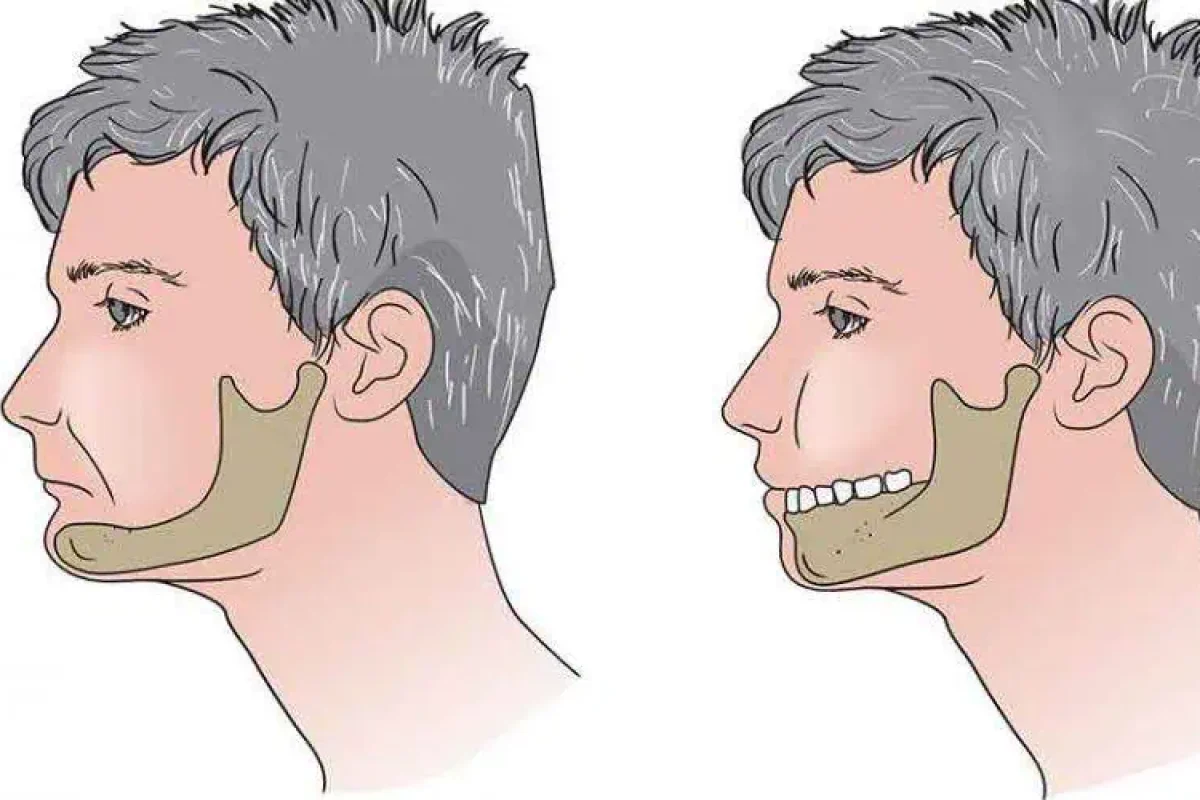 What Happens to Your Face and Jawline When You Lose Teeth
