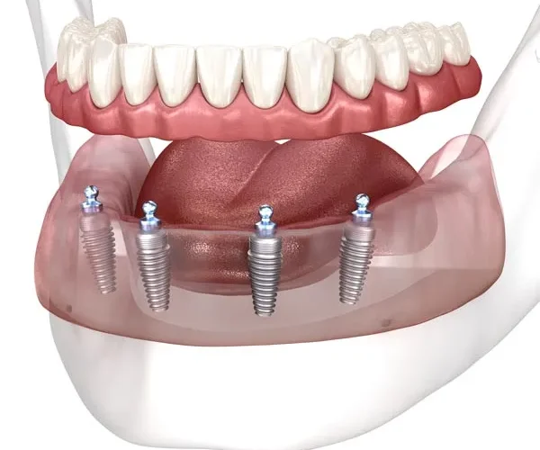 Clear and Best Choice for Dental Implant Snap-On Dentures