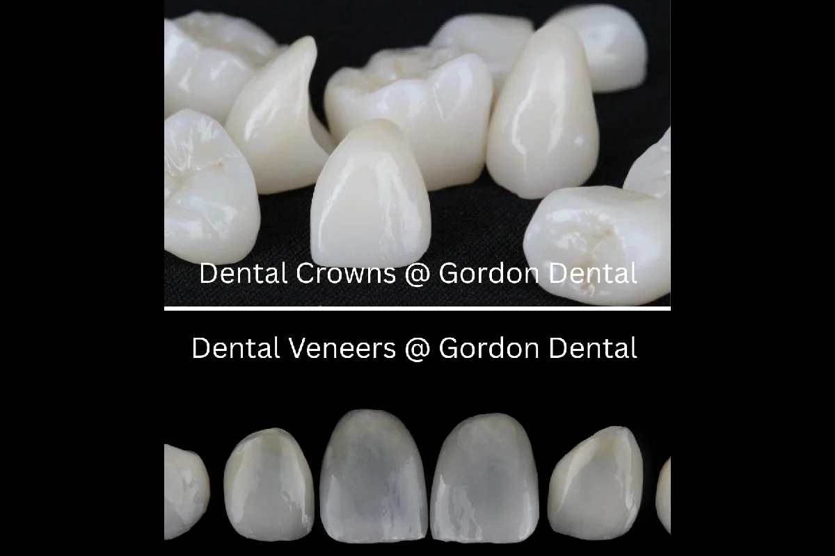 Porcelain Veneers vs. Crowns_ How to Choose the Best Option for Your Smile