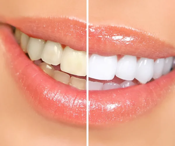 Professional Teeth Whitening in Kansas City