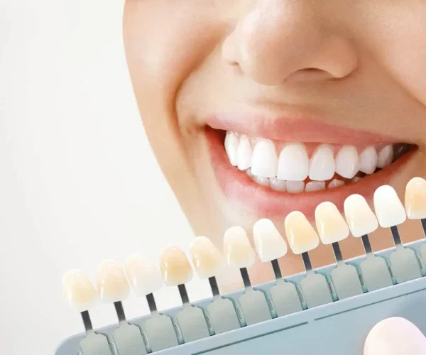 Professional Teeth Whitening in Kansas City, KS