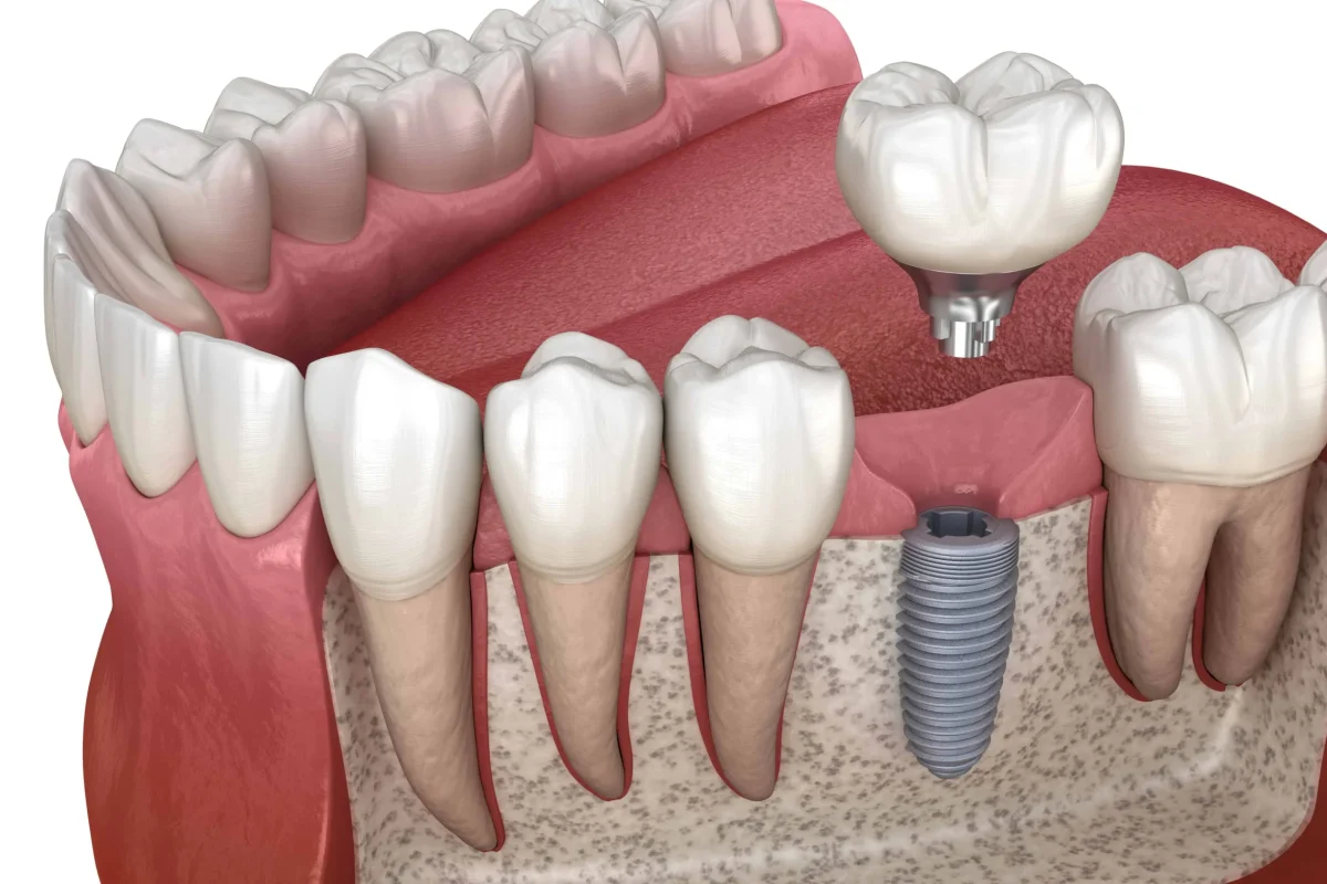Replacing a Failed Root Canal Tooth with a Dental Implant 1