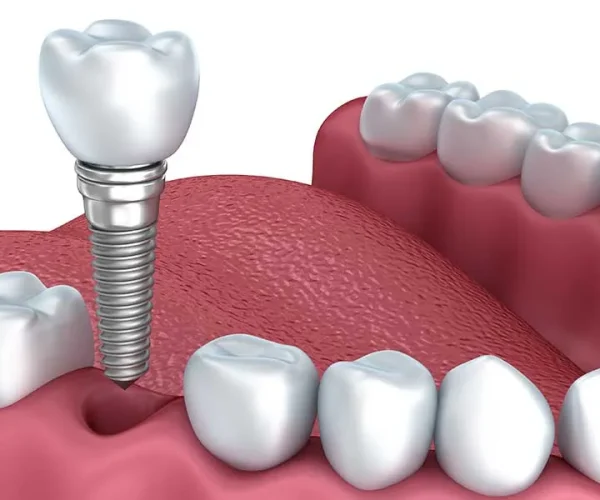Premium Veneers in Kansas City at Gordon Dental Implants and Cosmetics