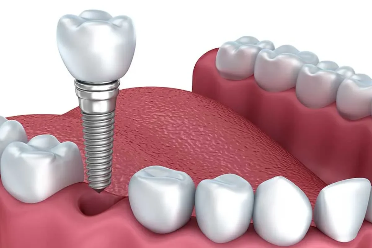 Single tooth dental implant procedure in Kansas City at Gordon Dental Implants and Cosmetics