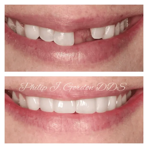 Single tooth Implant Dentist Overland Park Kansas City