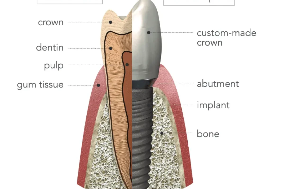 Smile Confidently with Denture Solutions: A Better Quality of Life