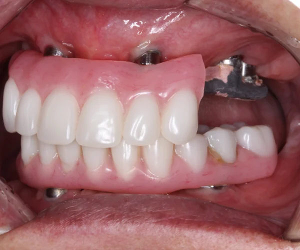 Smile Makeover for Broken and Failing Implants 2