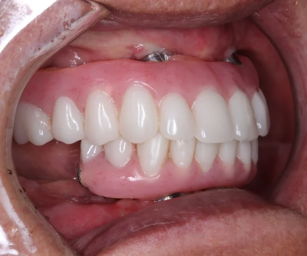 Smile Makeover for Broken and Failing Implants 4