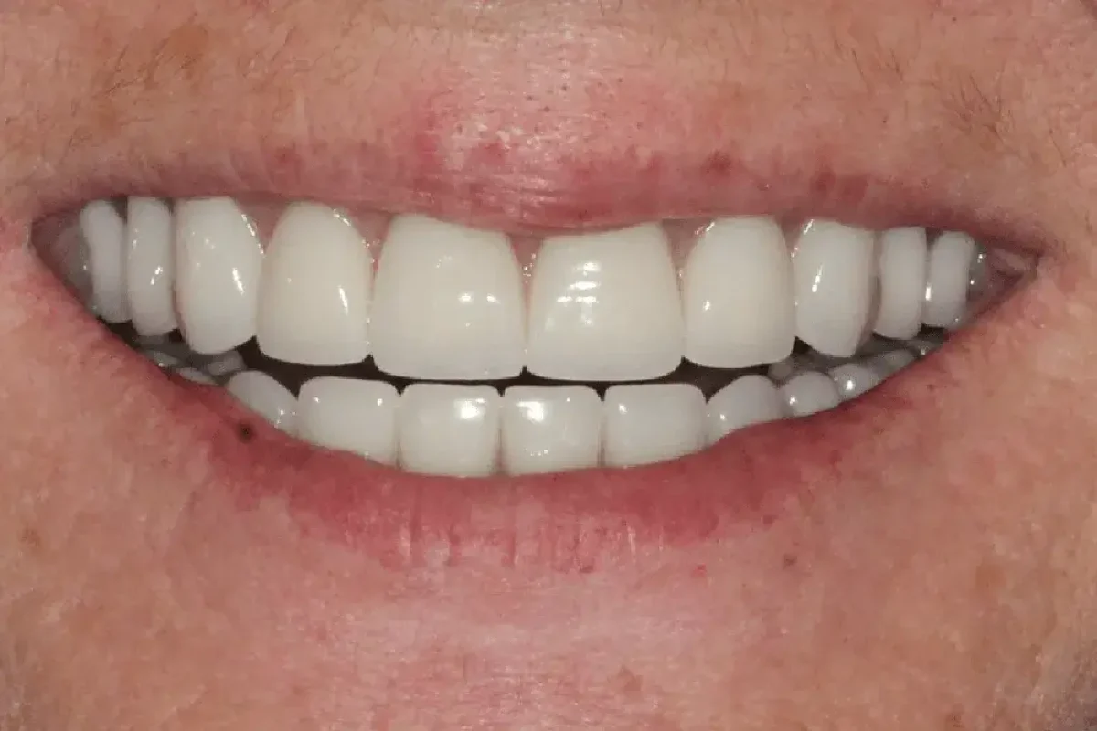 Snap-On Dentures in Kansas City, KS After