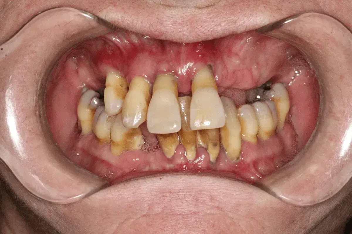 Snap-On Dentures Before