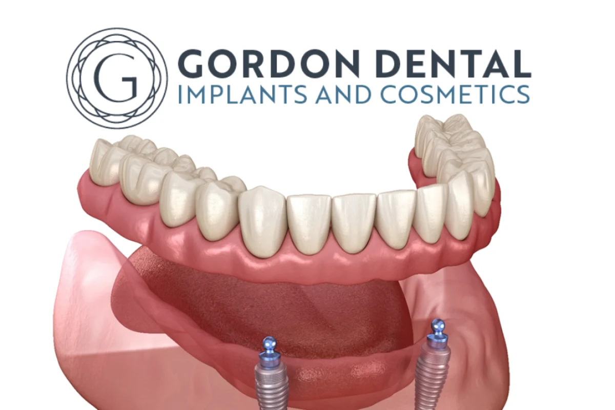 Snap-On Implant Dentures in Kansas City A Life-Changing Solution for Patients with Gum Disease