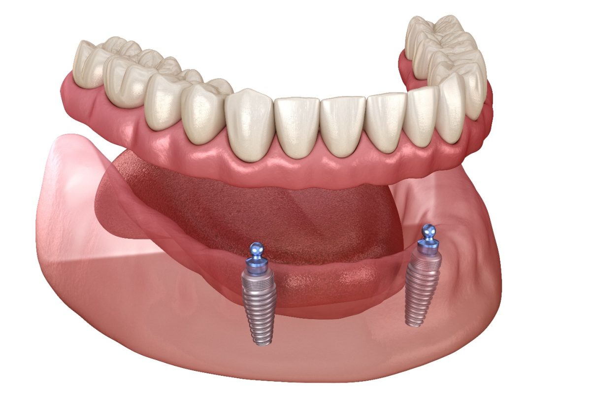 Snap-On Implant Dentures in Kansas City and Overland Park Kansas (1)
