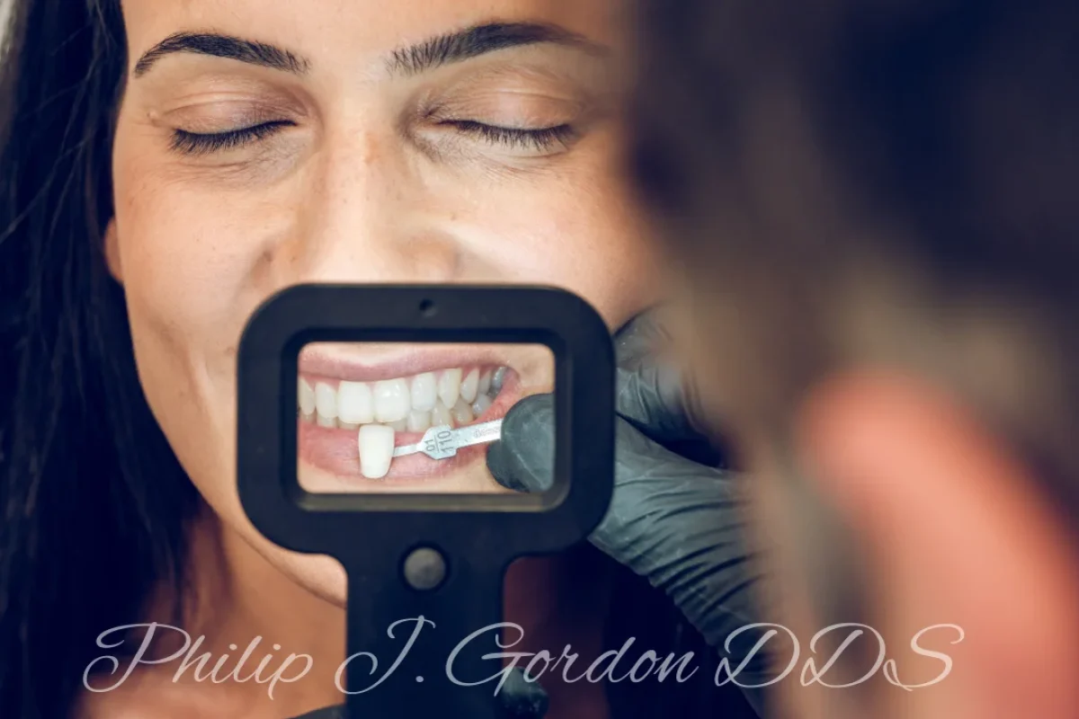 Veneers Last (2)
