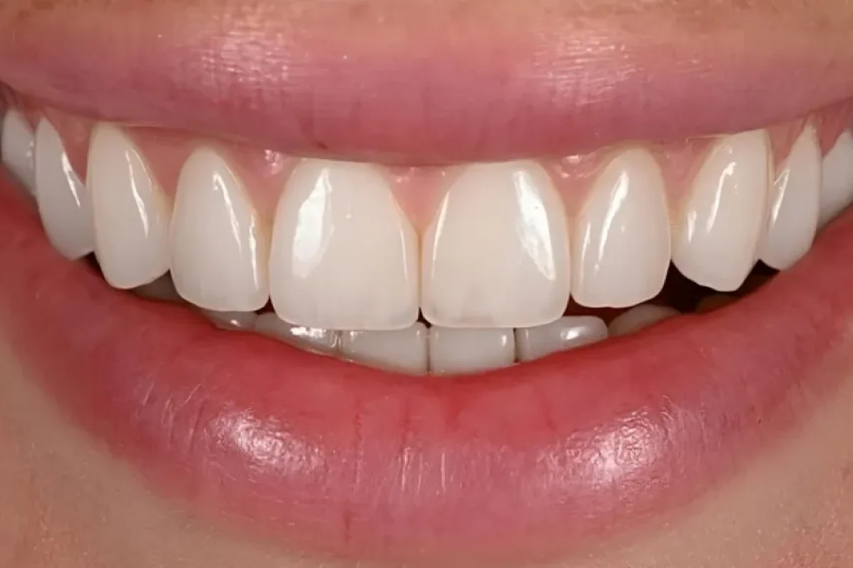 Veneers Smile Gallery After A in Kansas City