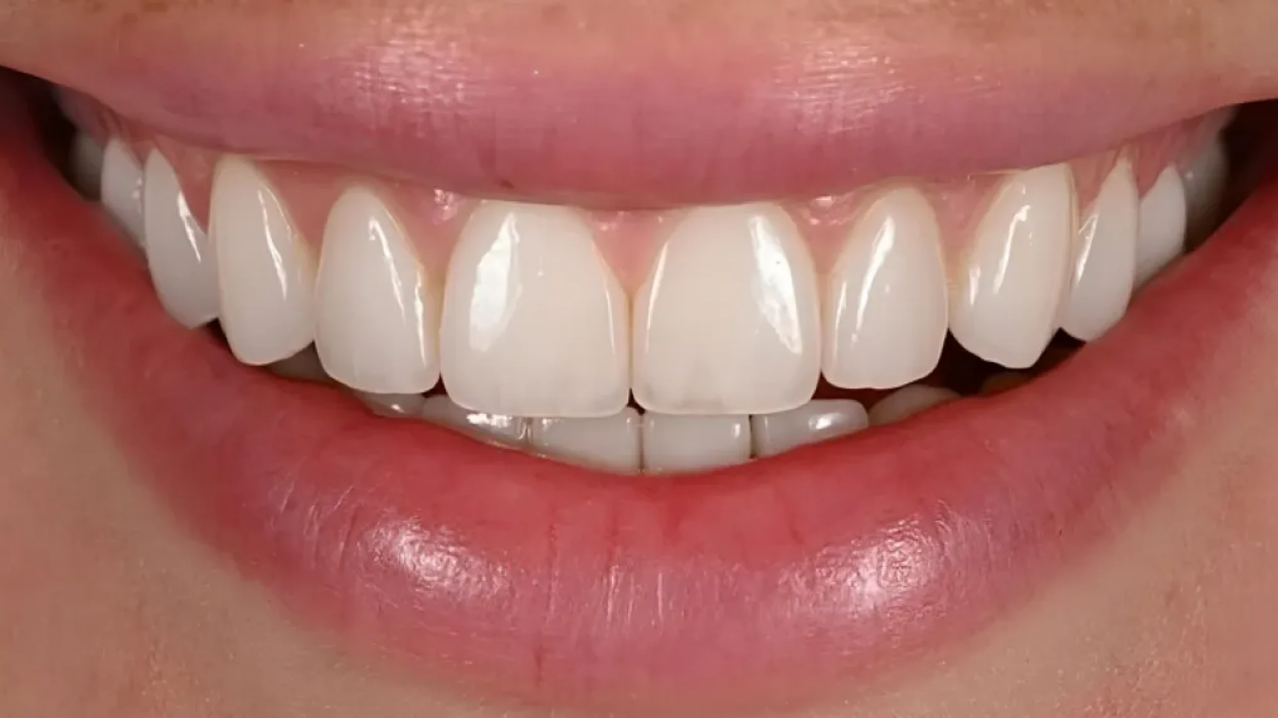 Veneers Smile Gallery After A in Kansas City