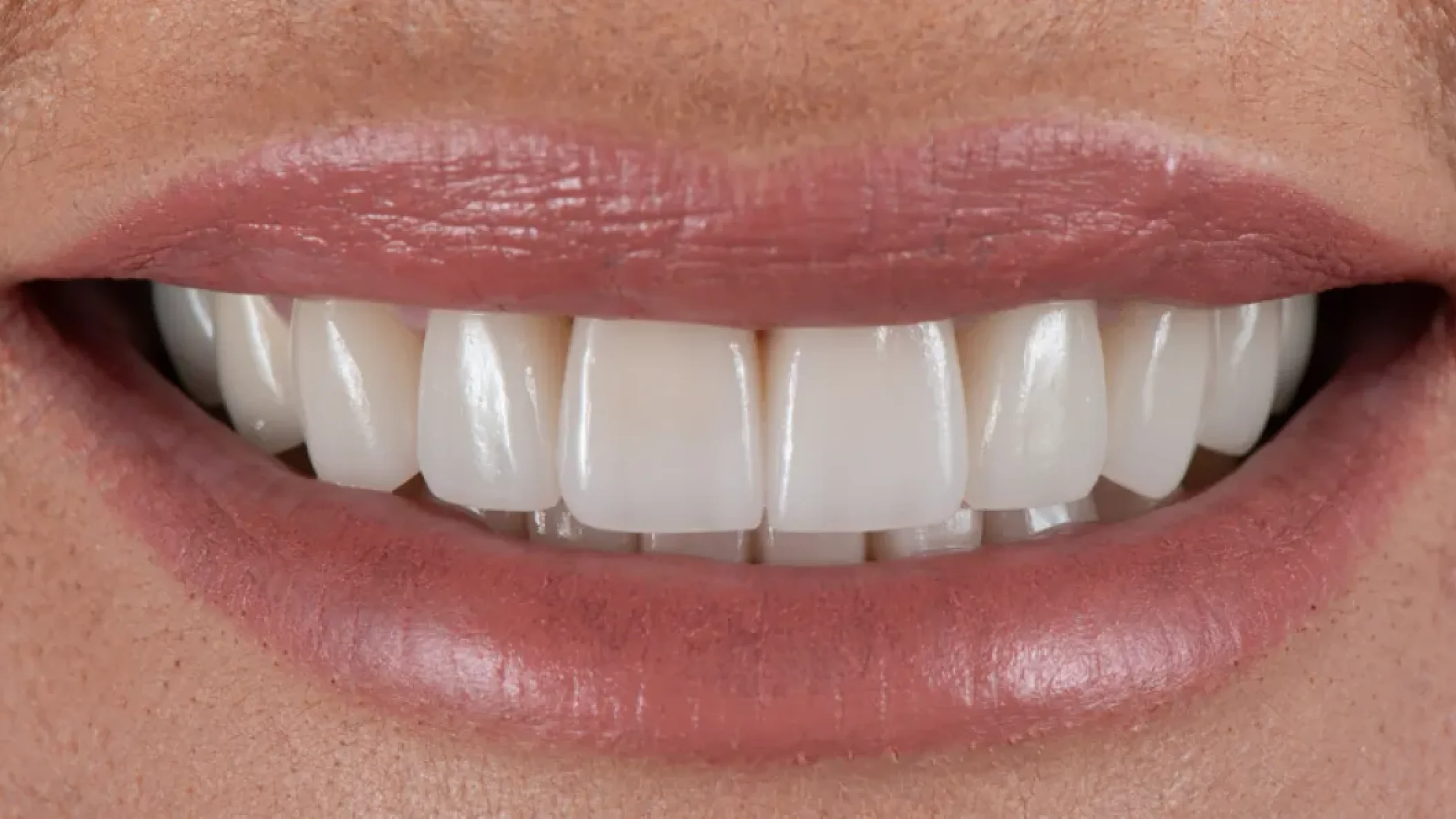 Veneers Smile Gallery After B in Kansas City