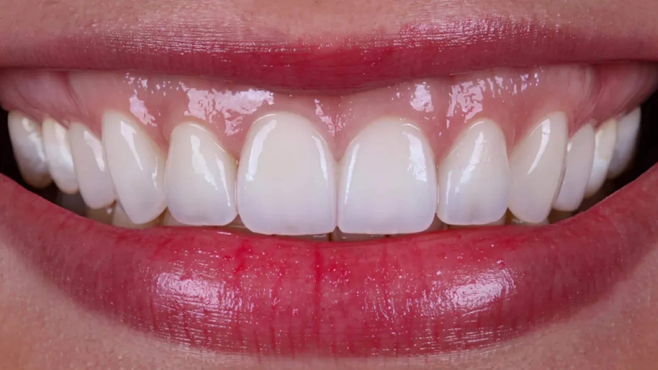 Veneers Smile Gallery After C in Kansas City