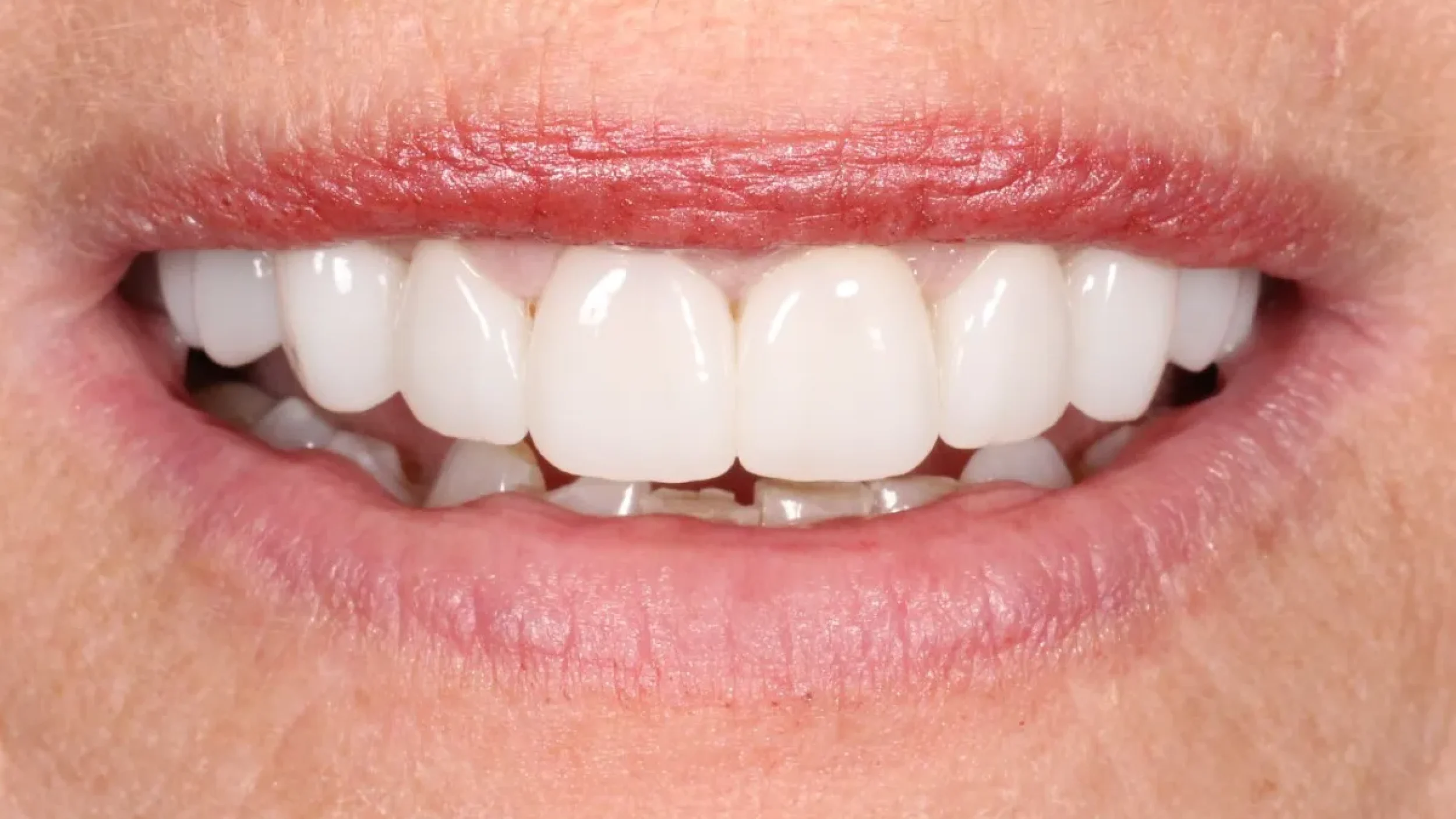 Veneers in Kansas City Smile Gallery After EE
