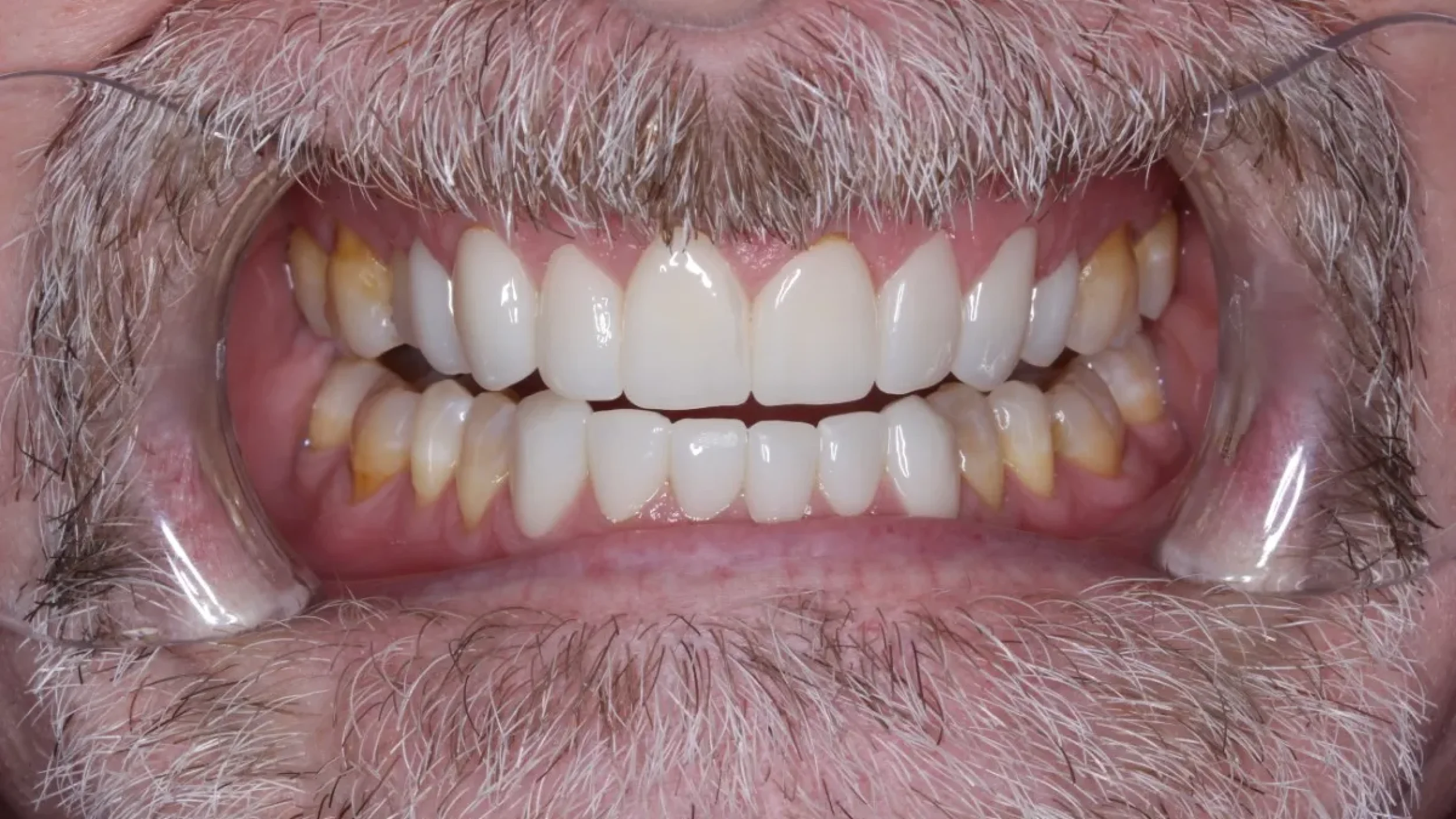 Veneers Smile Gallery After F in Kansas City