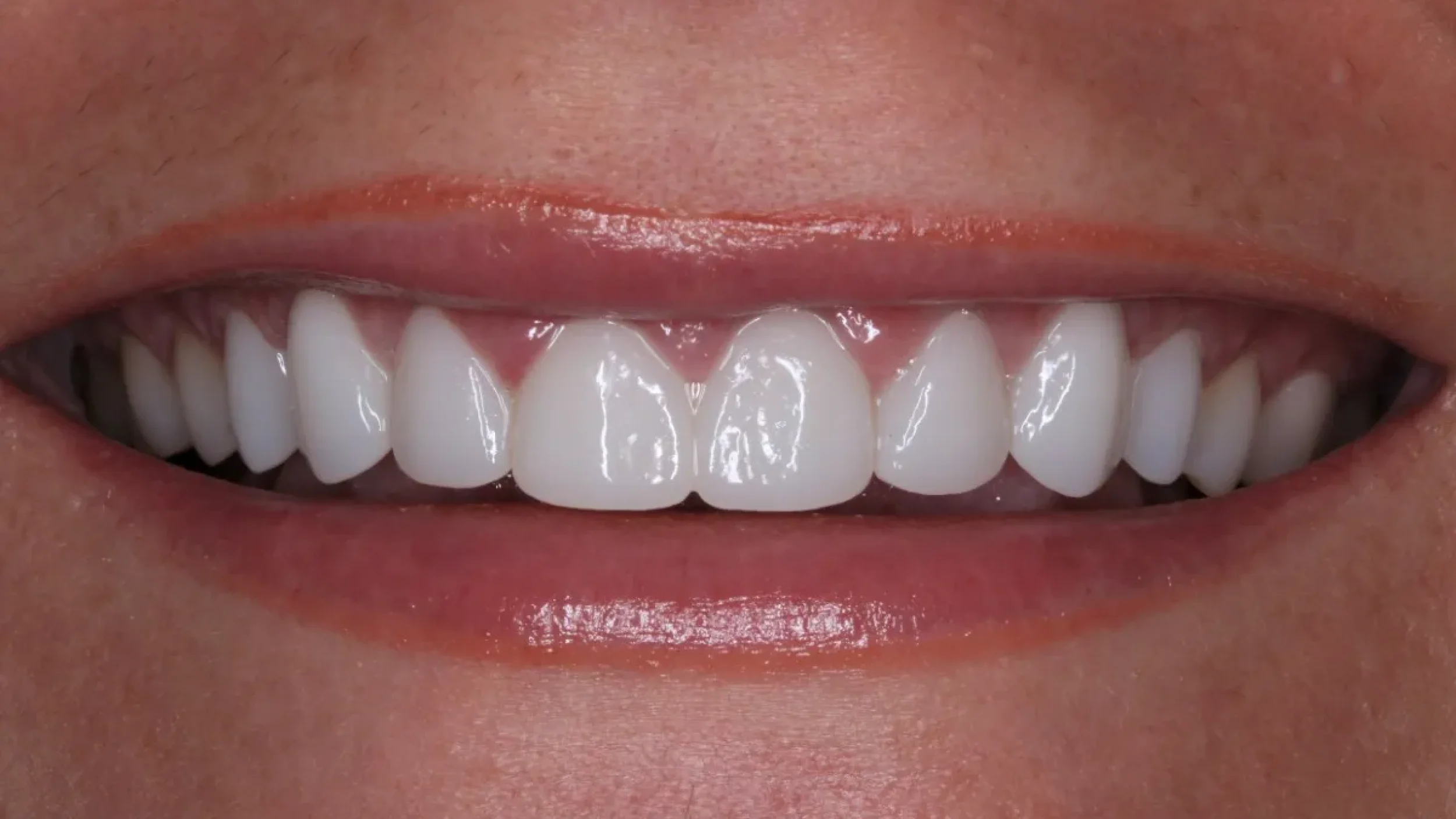 Veneers in Kansas City Smile Gallery After G