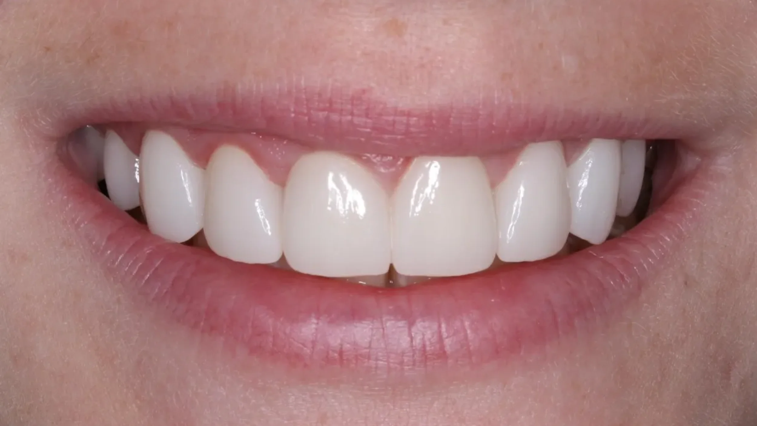 Veneers in Kansas City Smile Gallery After J