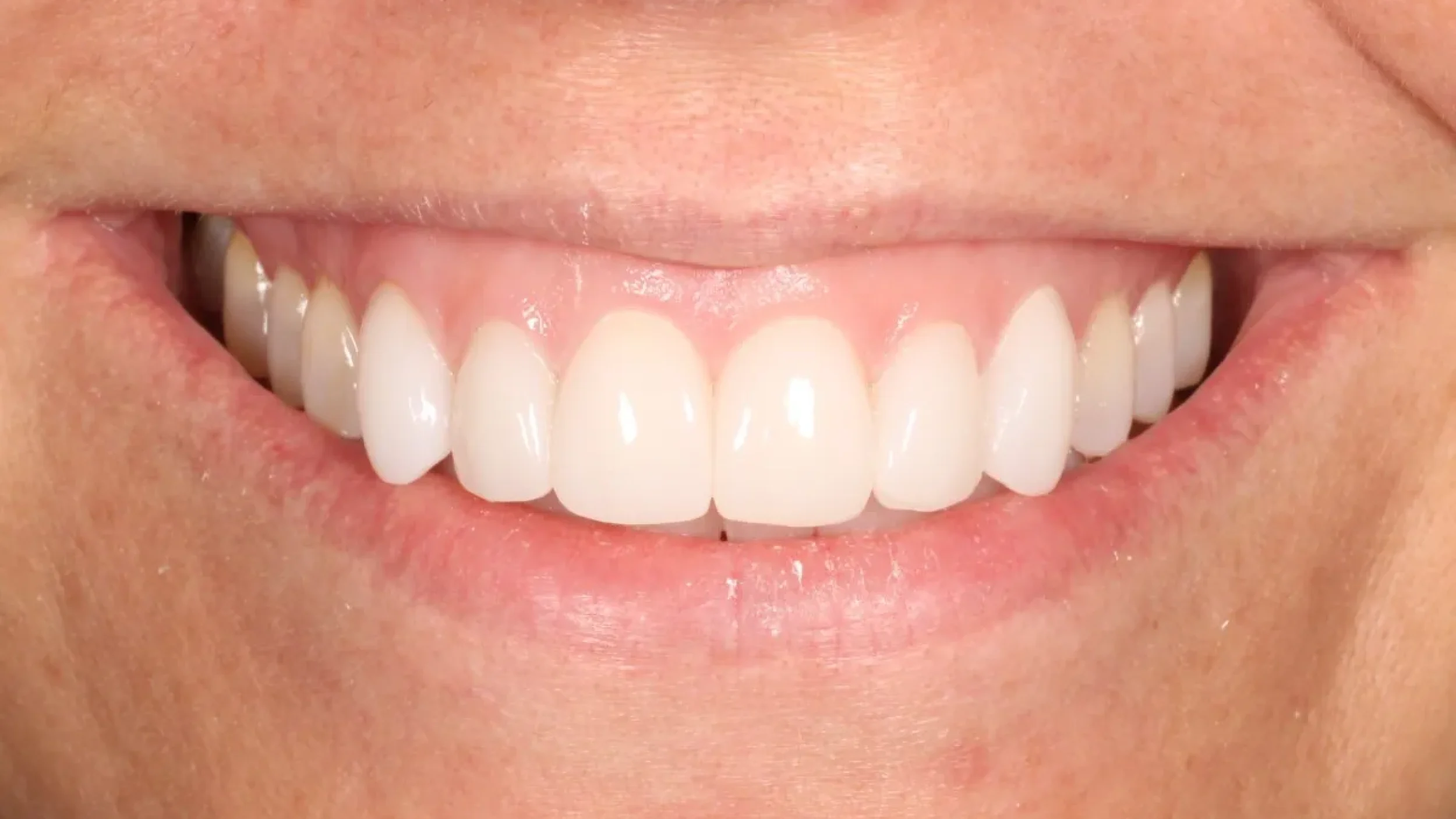 Veneers in Kansas City Smile Gallery After K