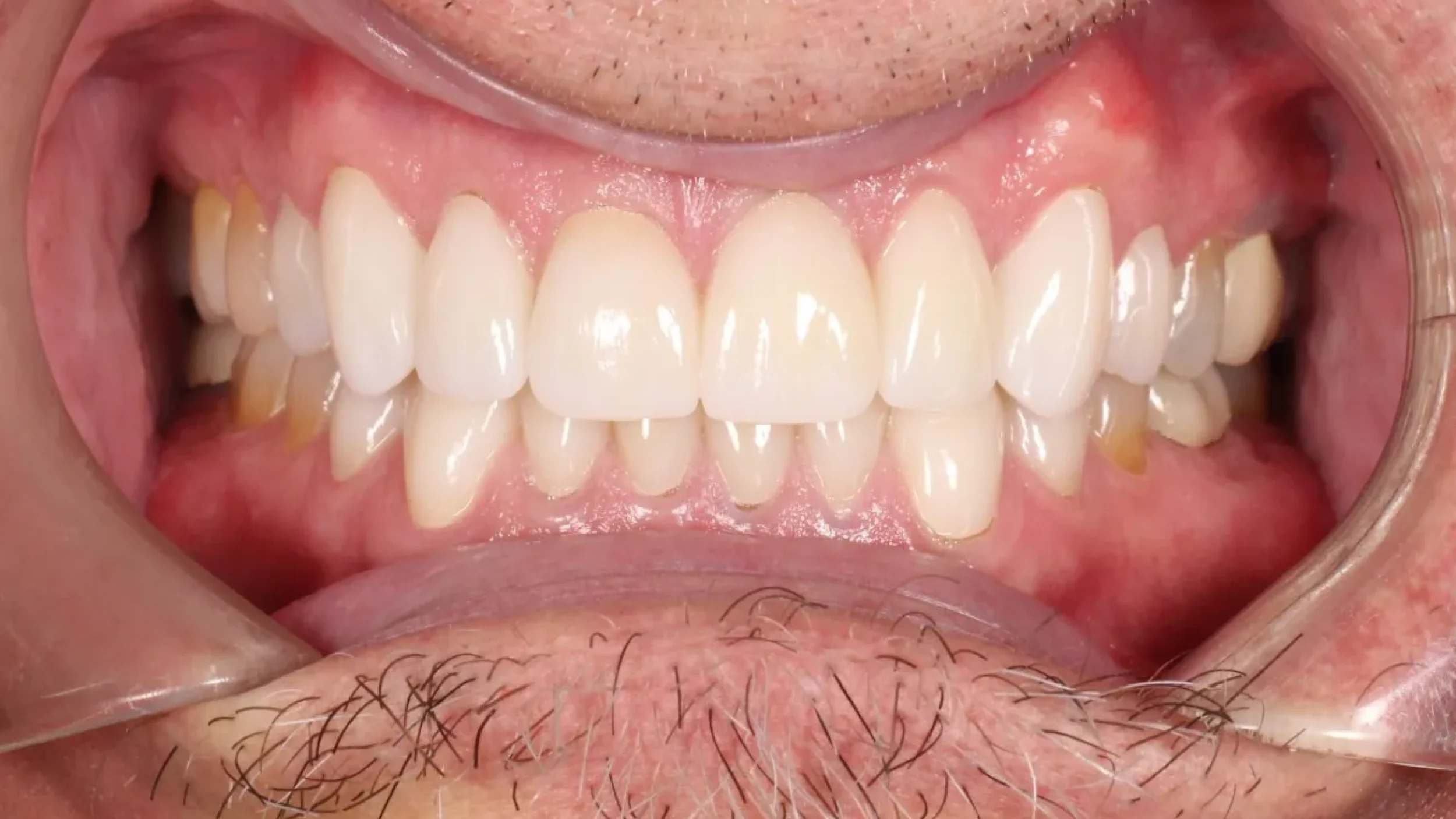 Veneers Smile Gallery After L in Kansas City