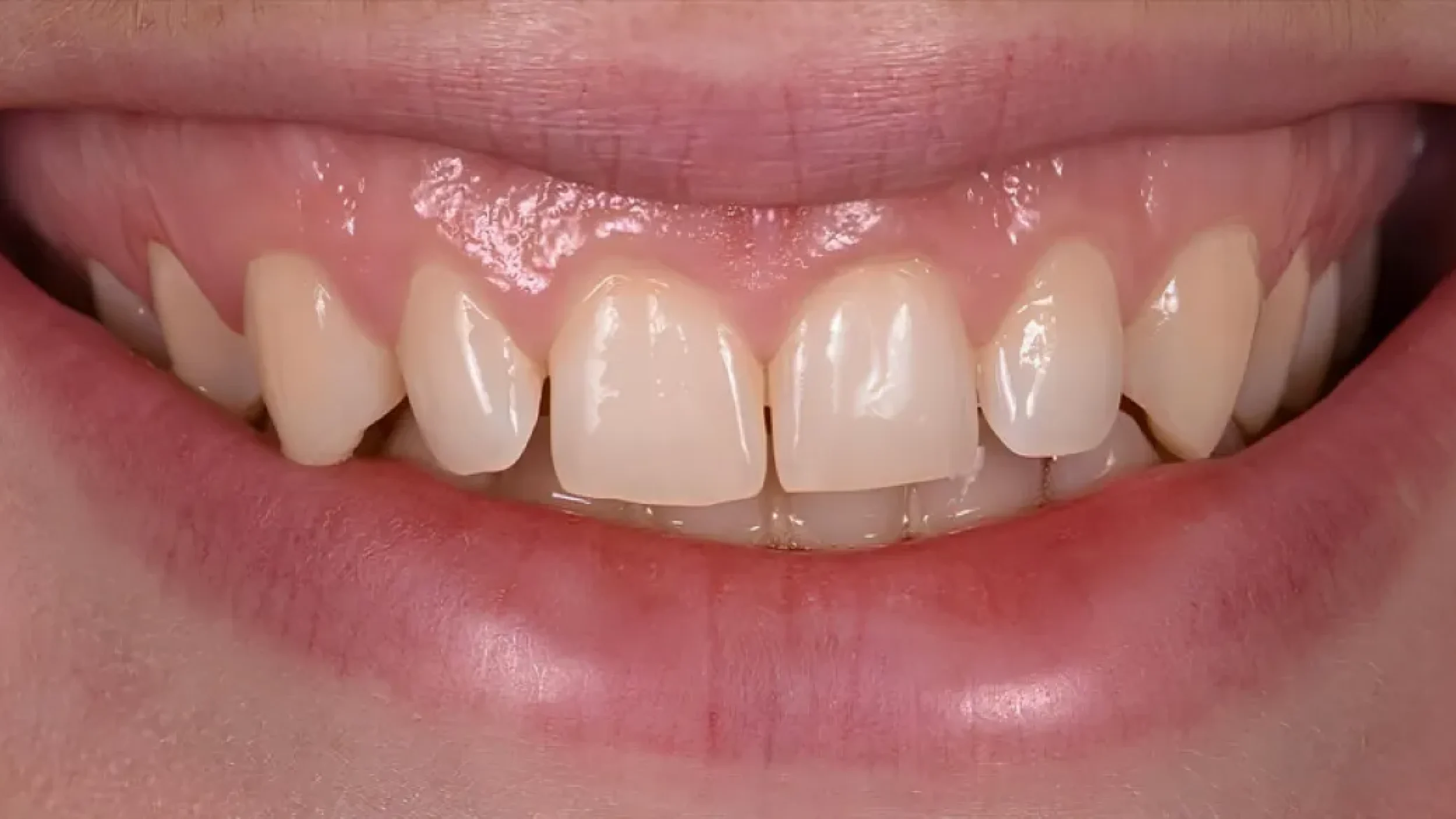 Porcelain Veneers Smile Gallery Before A in Kansas City