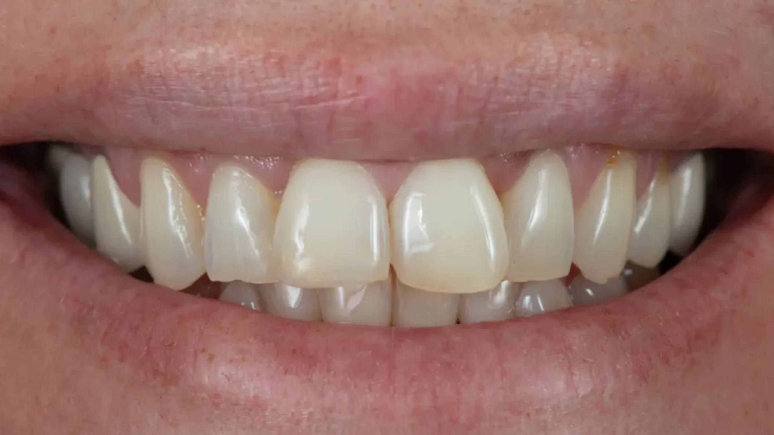 Porcelain Veneers Smile Gallery Before B in Kansas City