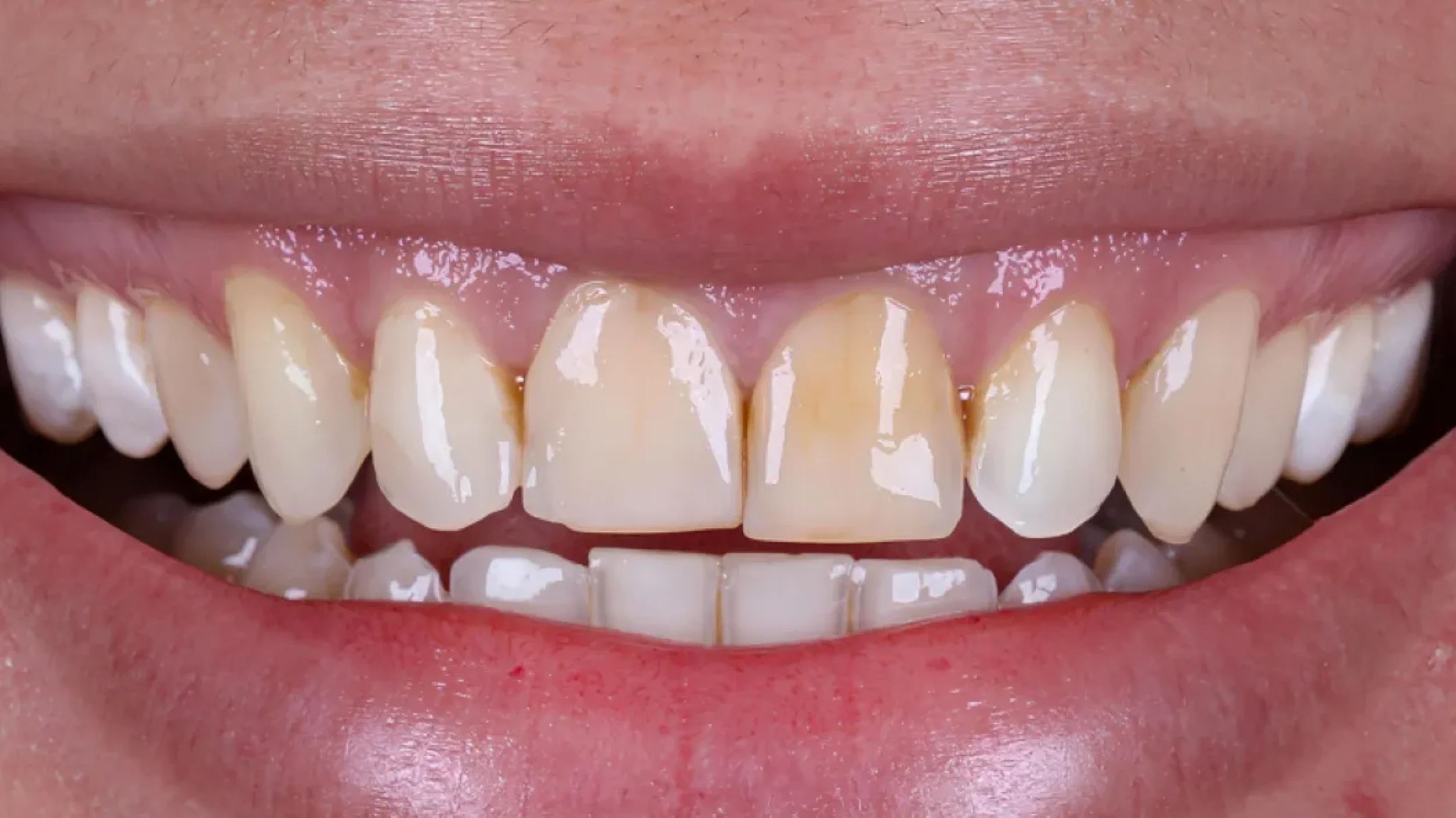 Porcelain Veneers Smile Gallery Before C in Kansas City