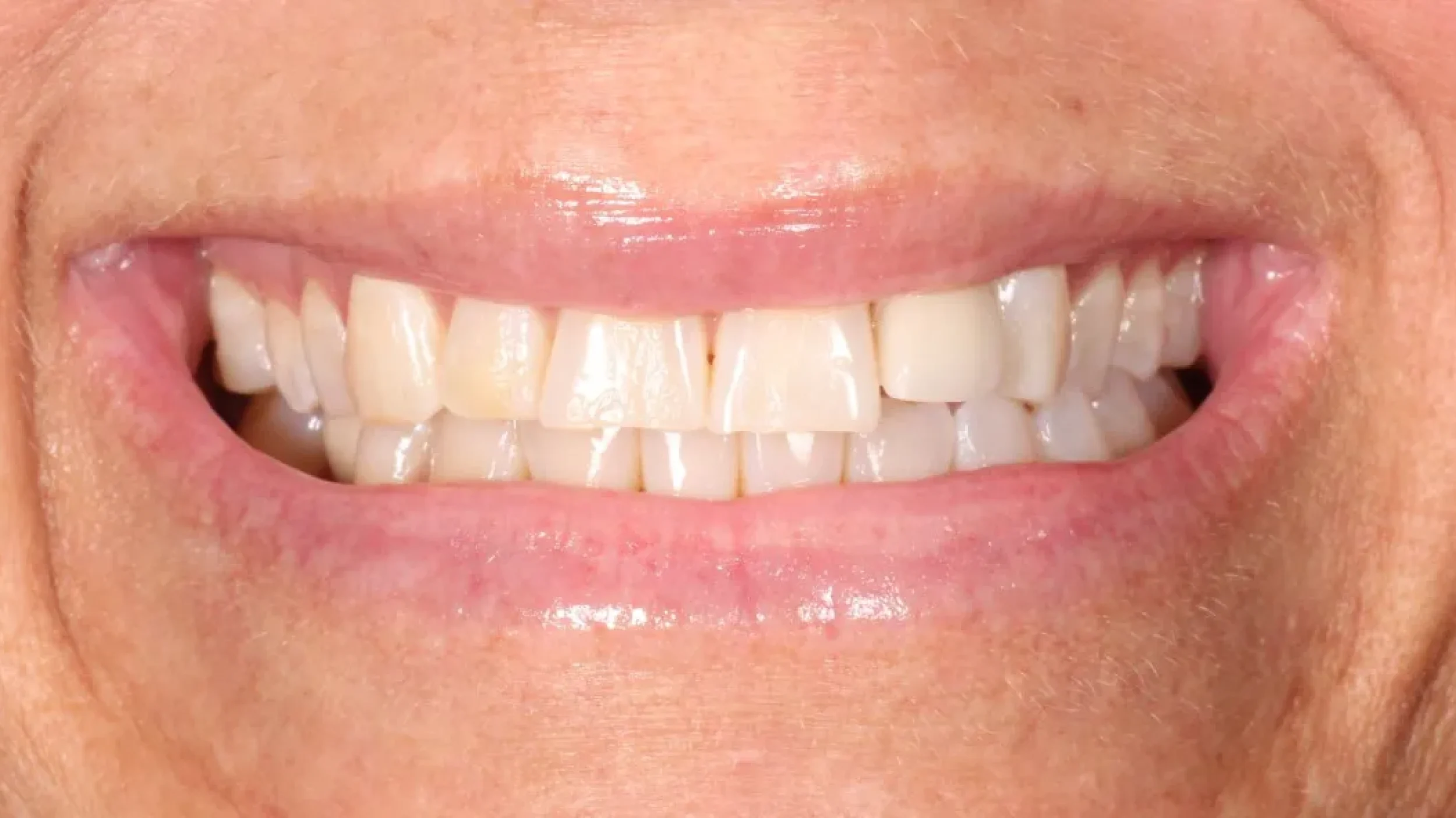 Porcelain Veneers Smile Gallery Before D in Kansas City