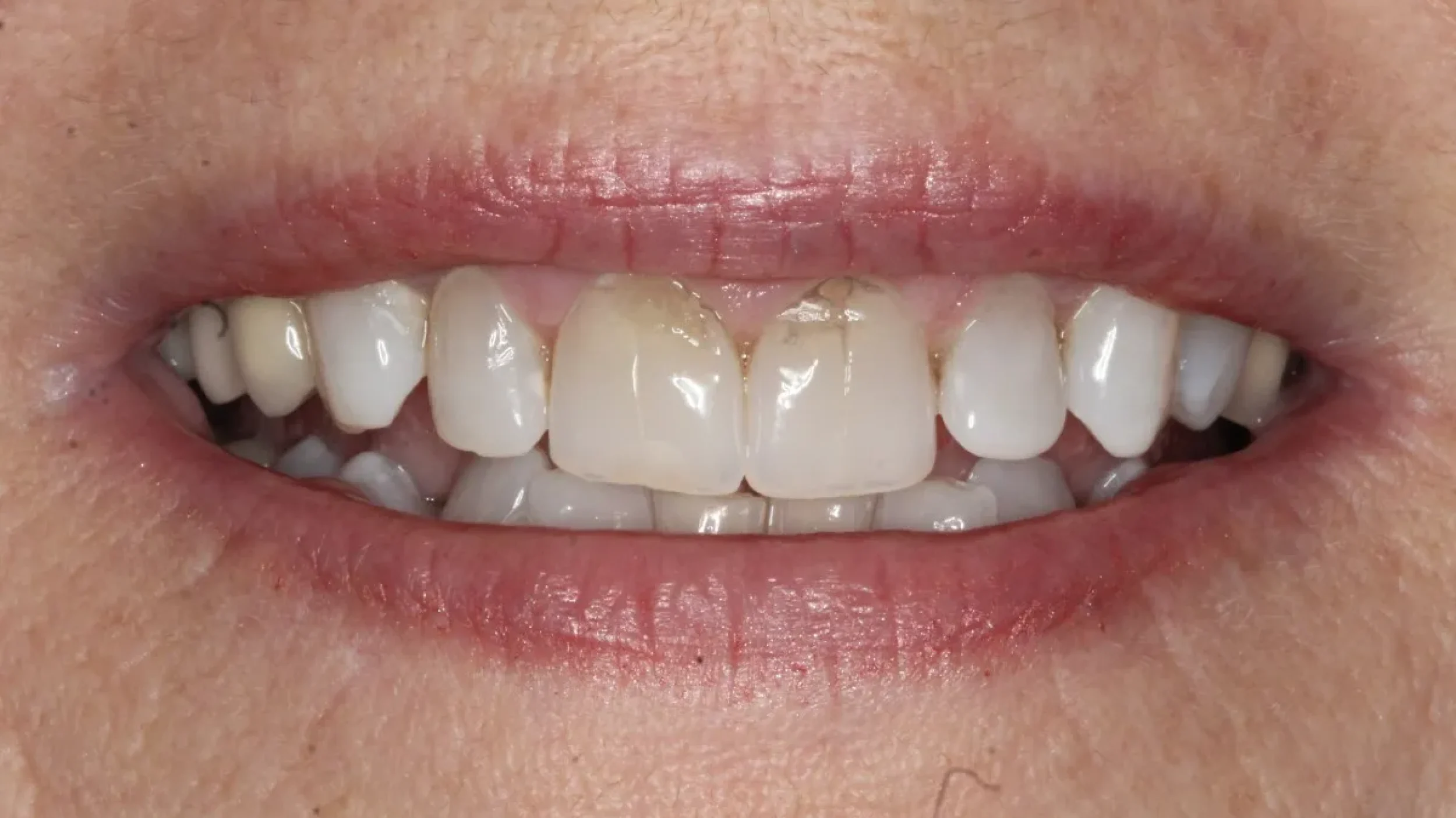 Porcelain Veneers in Kansas City Smile Gallery Before E