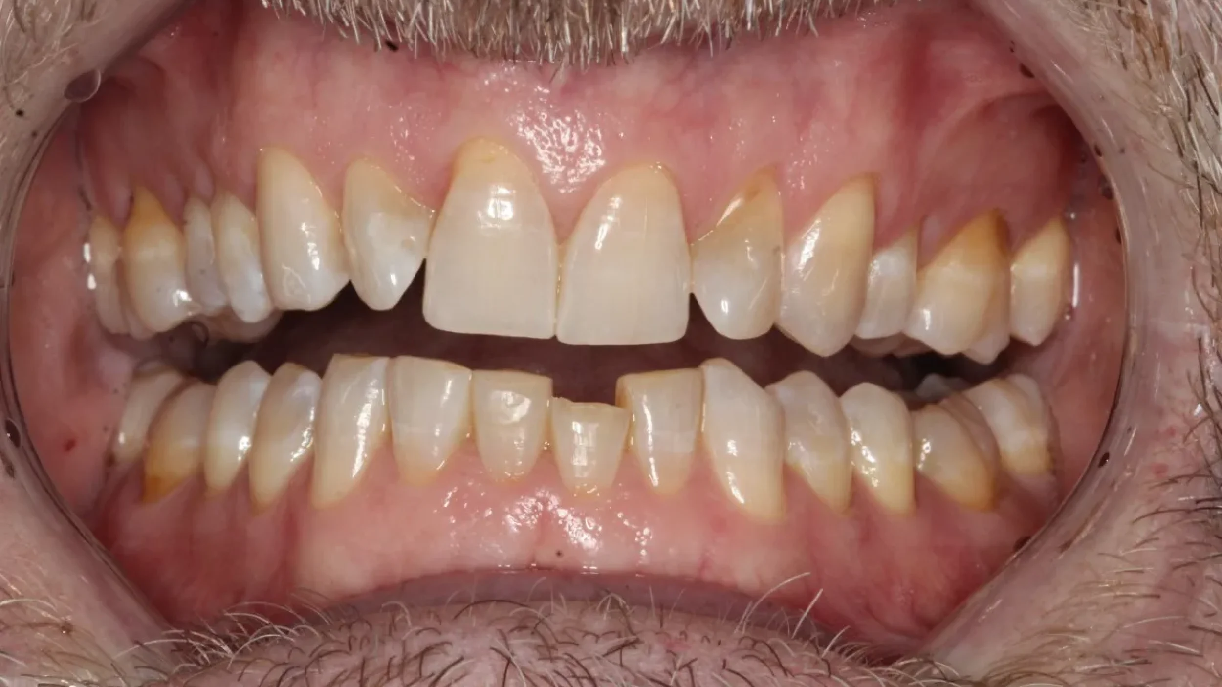 vVeneers in Kansas City Smile Gallery Before F