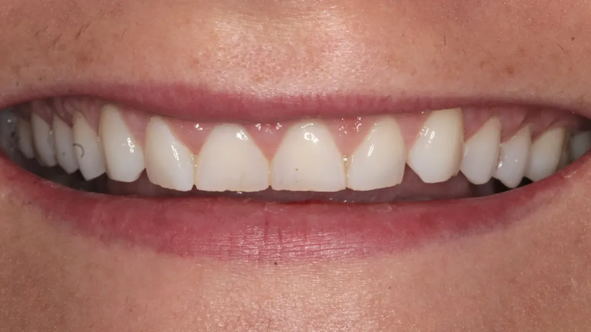 Porcelain Veneers Smile Gallery Before G in Kansas City