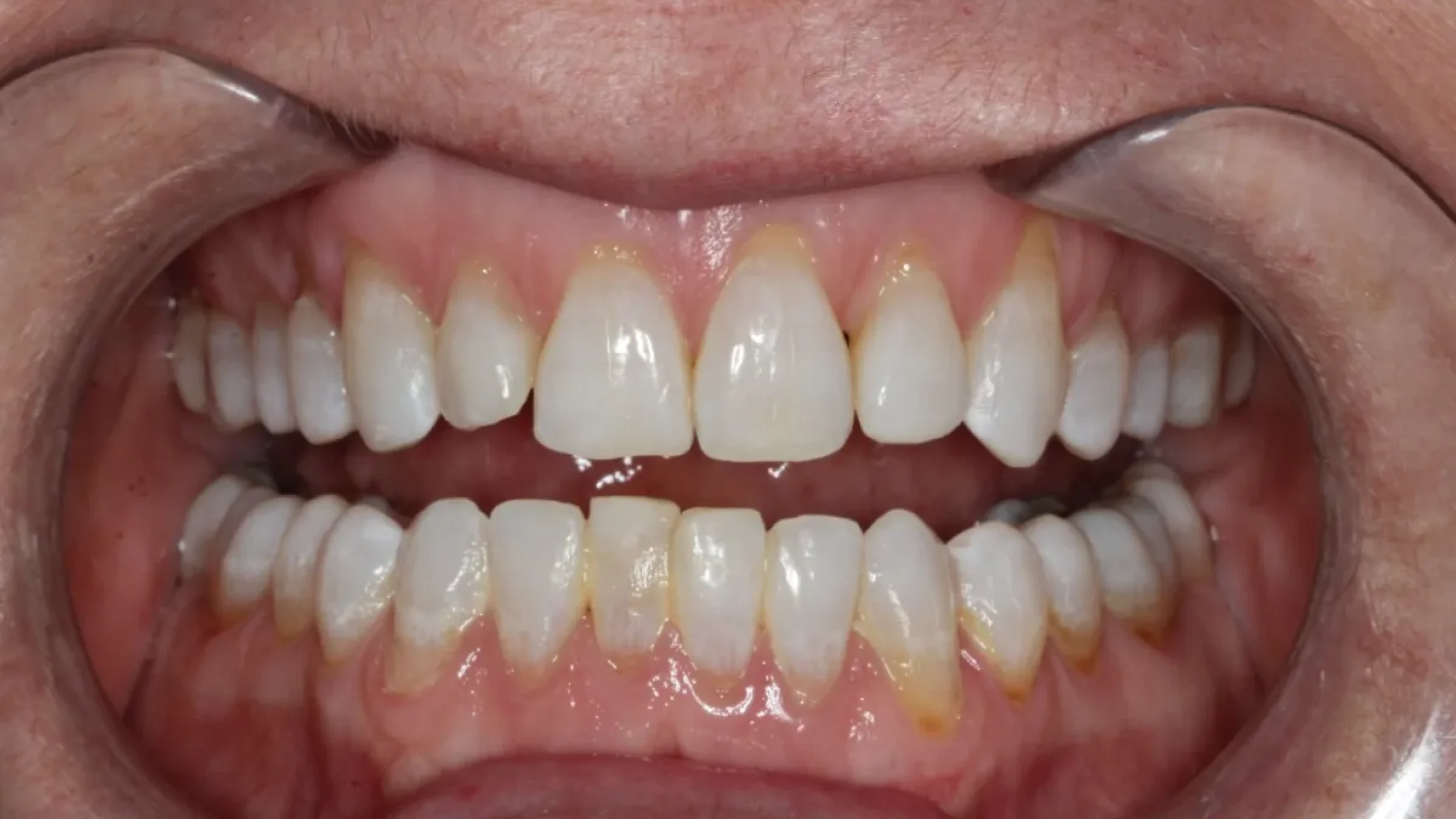 Porcelain Veneers Smile Gallery Before H in Kansas City
