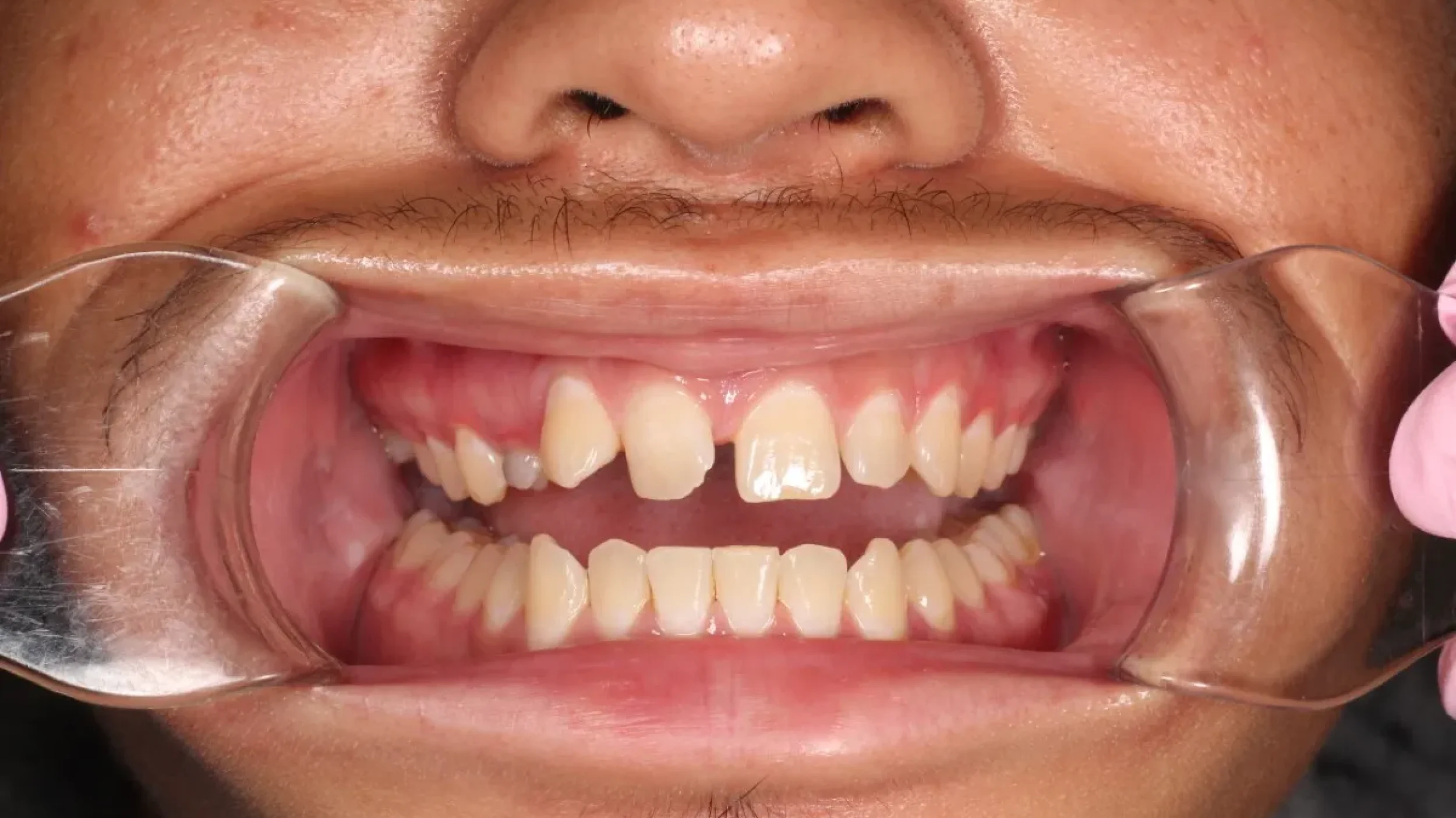 Porcelain Veneers in Kansas City Smile Gallery Before I
