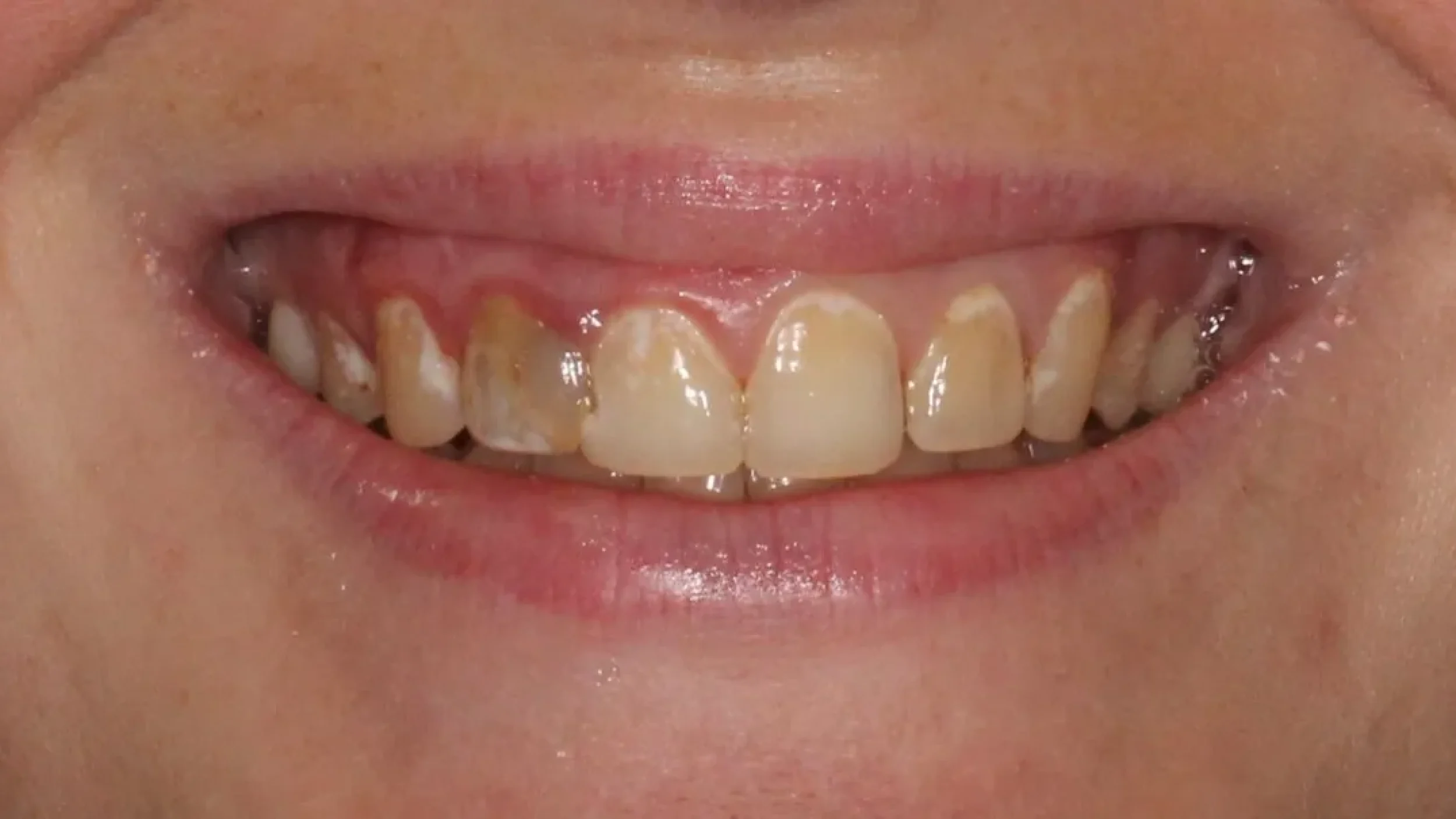 Porcelain Veneers in Kansas City Smile Gallery Before J