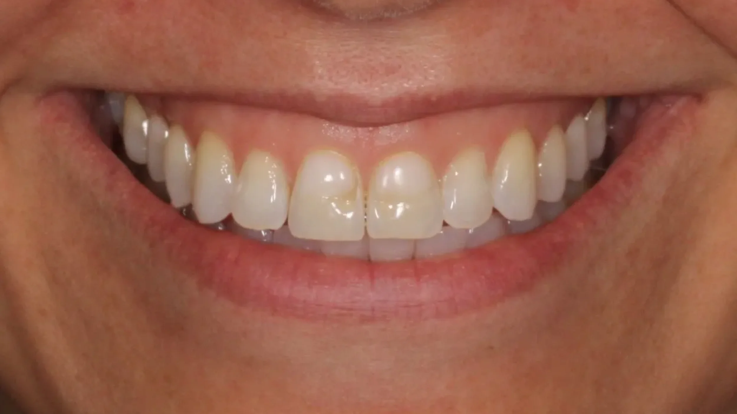 Porcelain Veneers Smile Gallery Before K in Kansas City