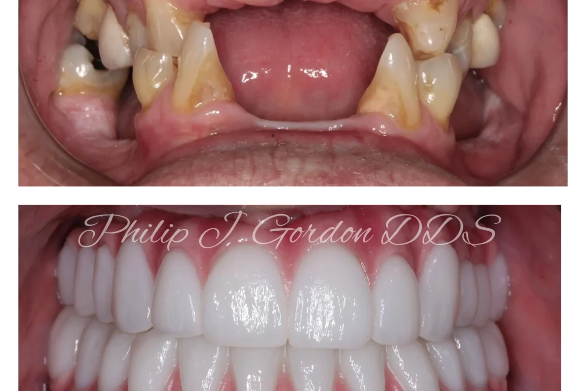 Zirconia vs. Acrylic Bridges