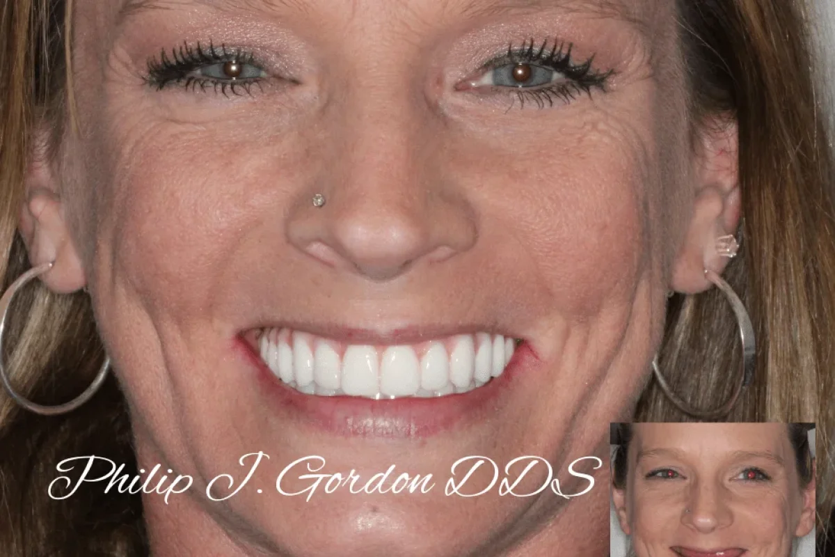 all-on-4-full-arch-before-after-patient-kansas-city