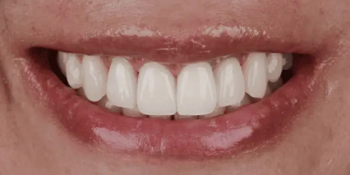 Full Mouth Crowns After in Kansas City