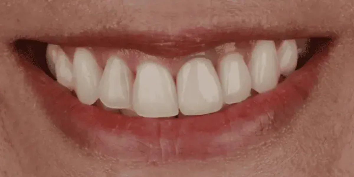 Full Mouth Crowns Before in Kansas City