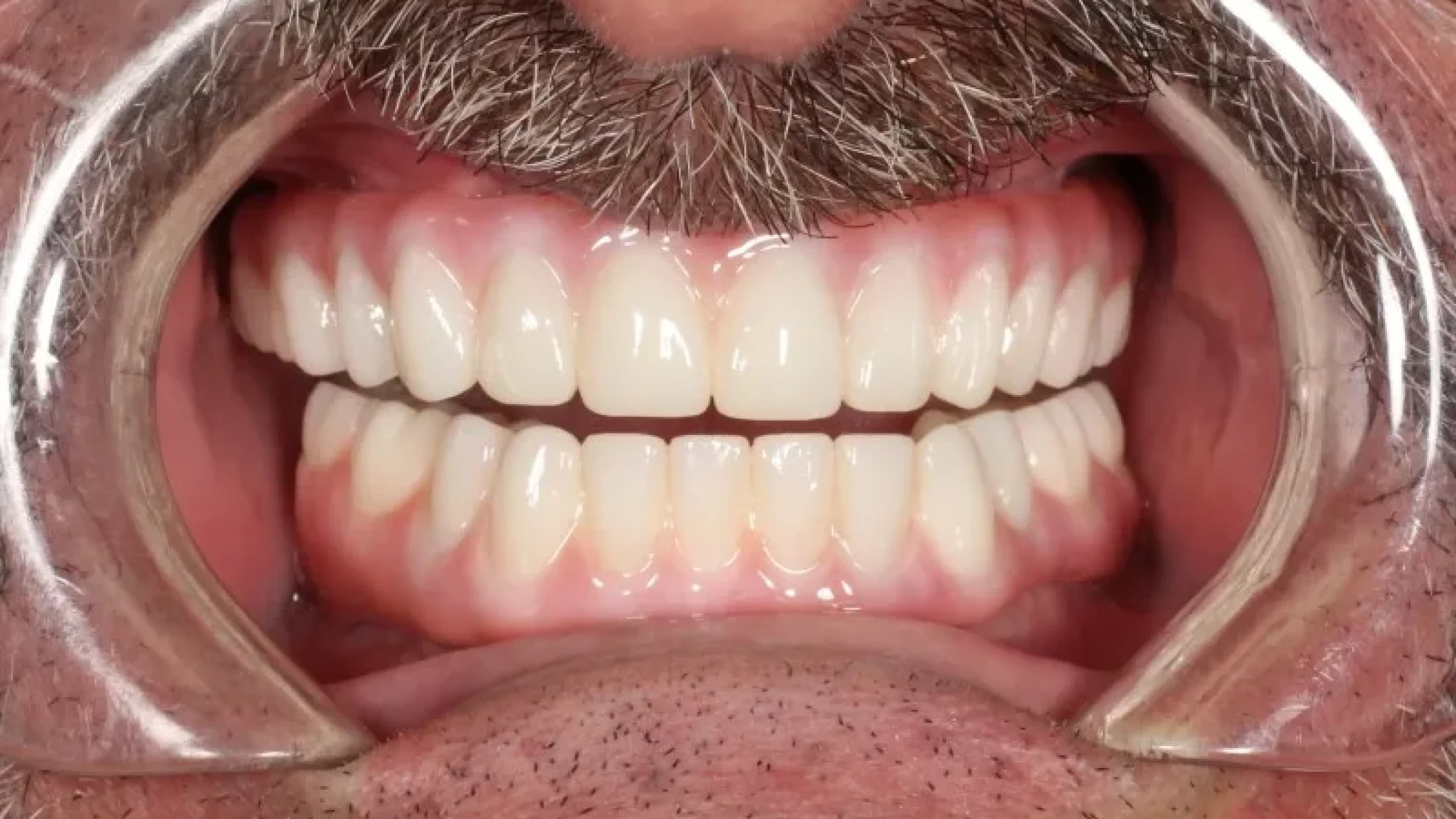 Gordon dental implants and cosmetics before after AA