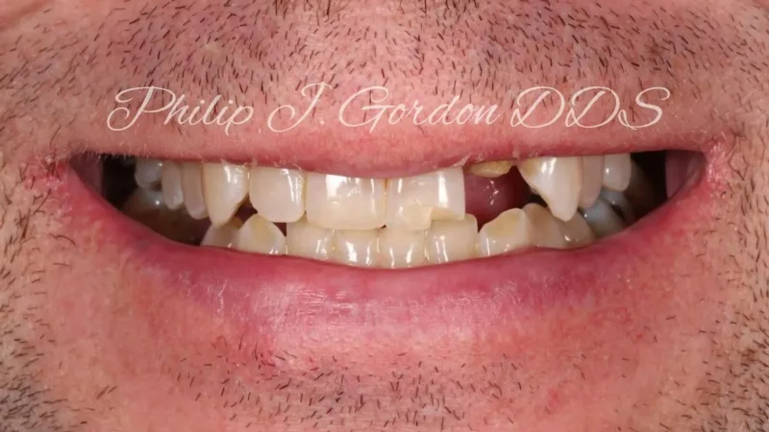 gordon dental implants and cosmetics before after SSS