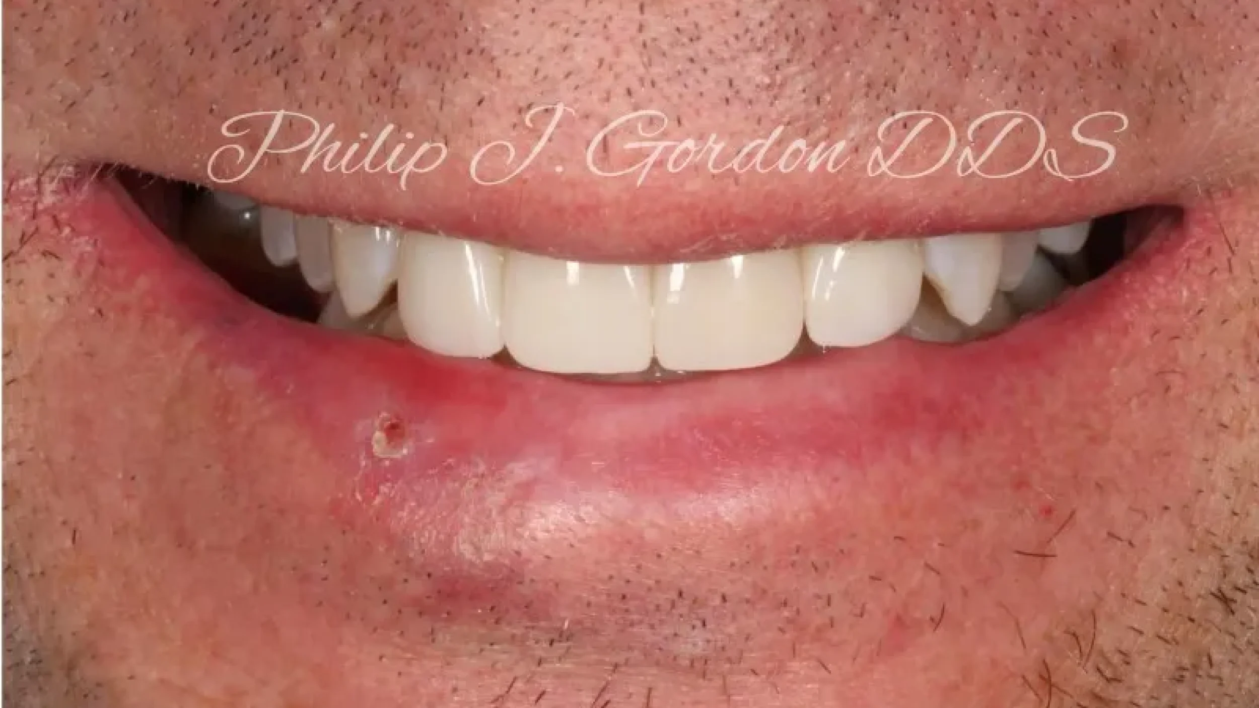 Gordon dental implants and cosmetics before after TTT