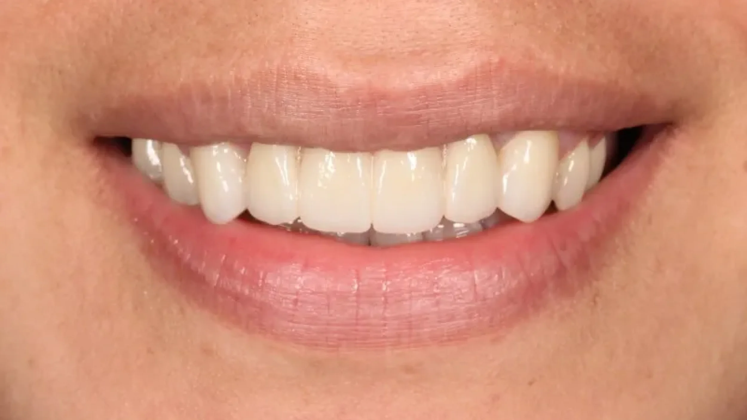 gordon dental implants and cosmetics before after V
