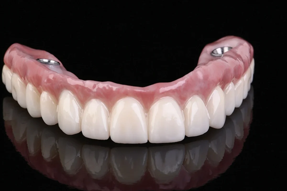 Full mouth All-on-4 dental implants result at Gordon Dental, showing natural-looking smile after implant procedure